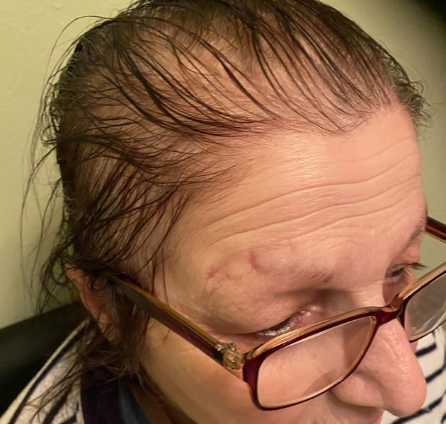 Ashot's mother, Shushik Baljyan, shows the mark where she hit her head from her fall